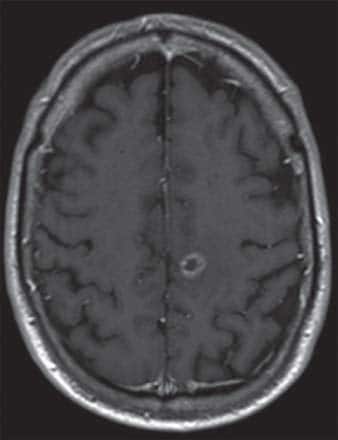 métastases  dans l’hémisphère gauche du cerveau secondaire à un cancer du poumon - image A