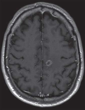 métastases dans l’hémisphère gauche du cerveau secondaire à un cancer du poumon B